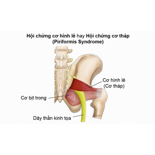 1.2. Nguyên nhân gây đau thần kinh tọa