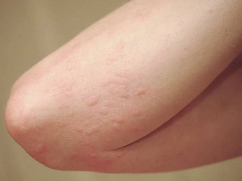 Dị ứng, nổi mẩn đỏ, ngứa